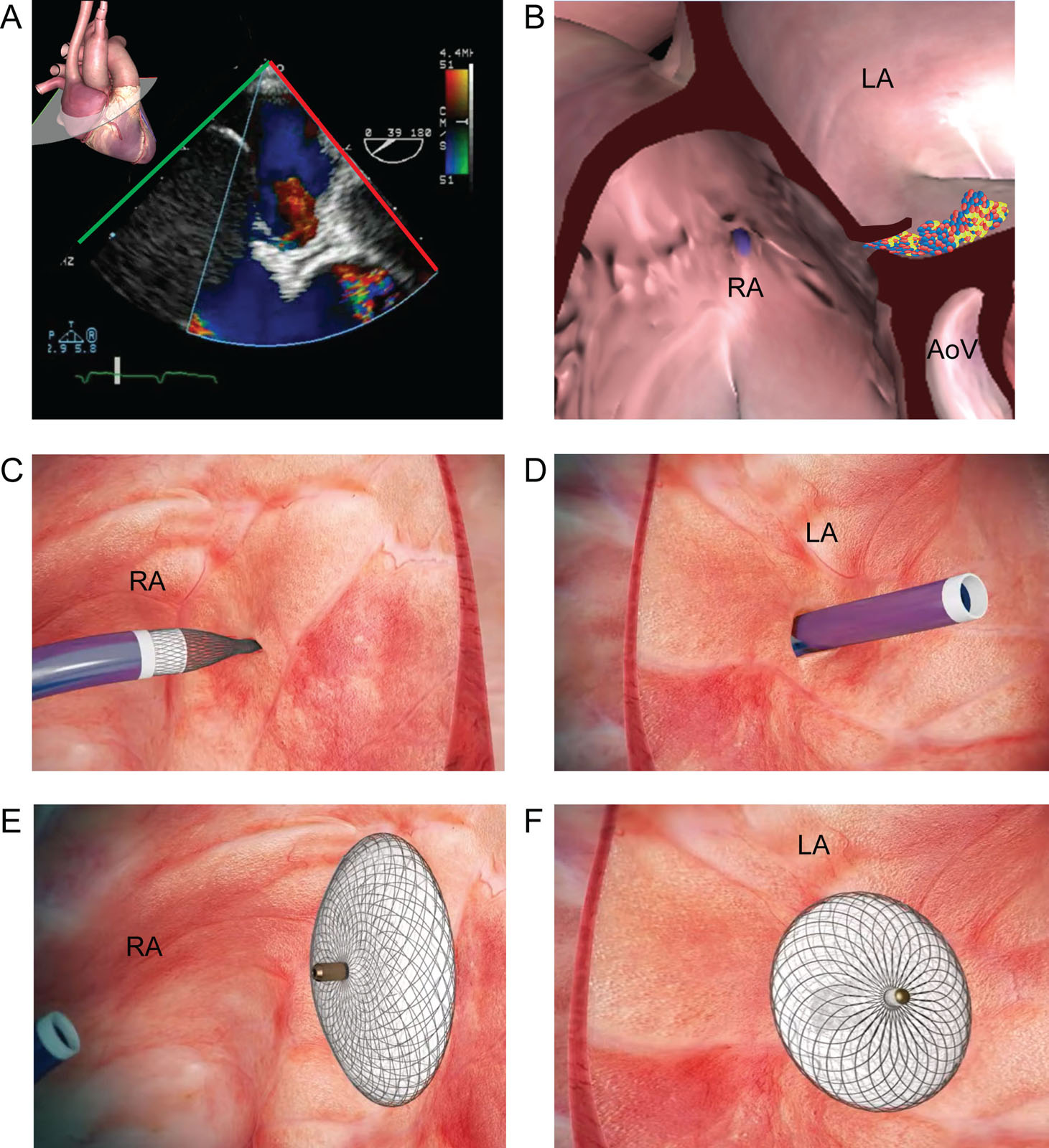 PFO after LVAD. This is a hypoxemic patient post LVAD implantation with a PFO. (A,B) Zoomed ME RV inflow/outflow view with CFI at 39° shows a significant right-to-left shunt through a PFO (arrow). (C,D) Insertion of the catheter through the interatrial septum and (E,F) PFO closure using a trans-catheter Amplatzer™ device (Abbott) closure.<em> Abbreviations</em>: AoV, aortic valve; CFI, color flow imaging; LA, left atrium; LVAD, left ventricular assist device; ME, mid-esophageal; PFO, patent foramen ovale; RA, right atrium; RV, right ventricular. Photo courtesy of Abbott.<i class='fa fa-video-camera' aria-hidden='true'></i>