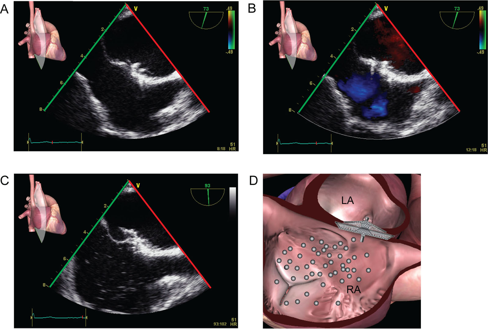 Device closure function. These ME bicaval views show the assessment of residual shunt through the PFO after closure device implantation. (A) This is a successfully deployed BioSTAR<sup>®</sup> device through a PFO undergoing (B) assessment of residual left-to-right shunt with CFI and (C, D) residual right-to-left shunt with agitated saline micro-bubble contrast injection.<em> Abbreviations</em>: CFI, color flow imaging; LA, left atrium; ME, mid-esophageal; PFO, patent foramen ovale; RA, right atrium. <i class='fa fa-video-camera' aria-hidden='true'></i>