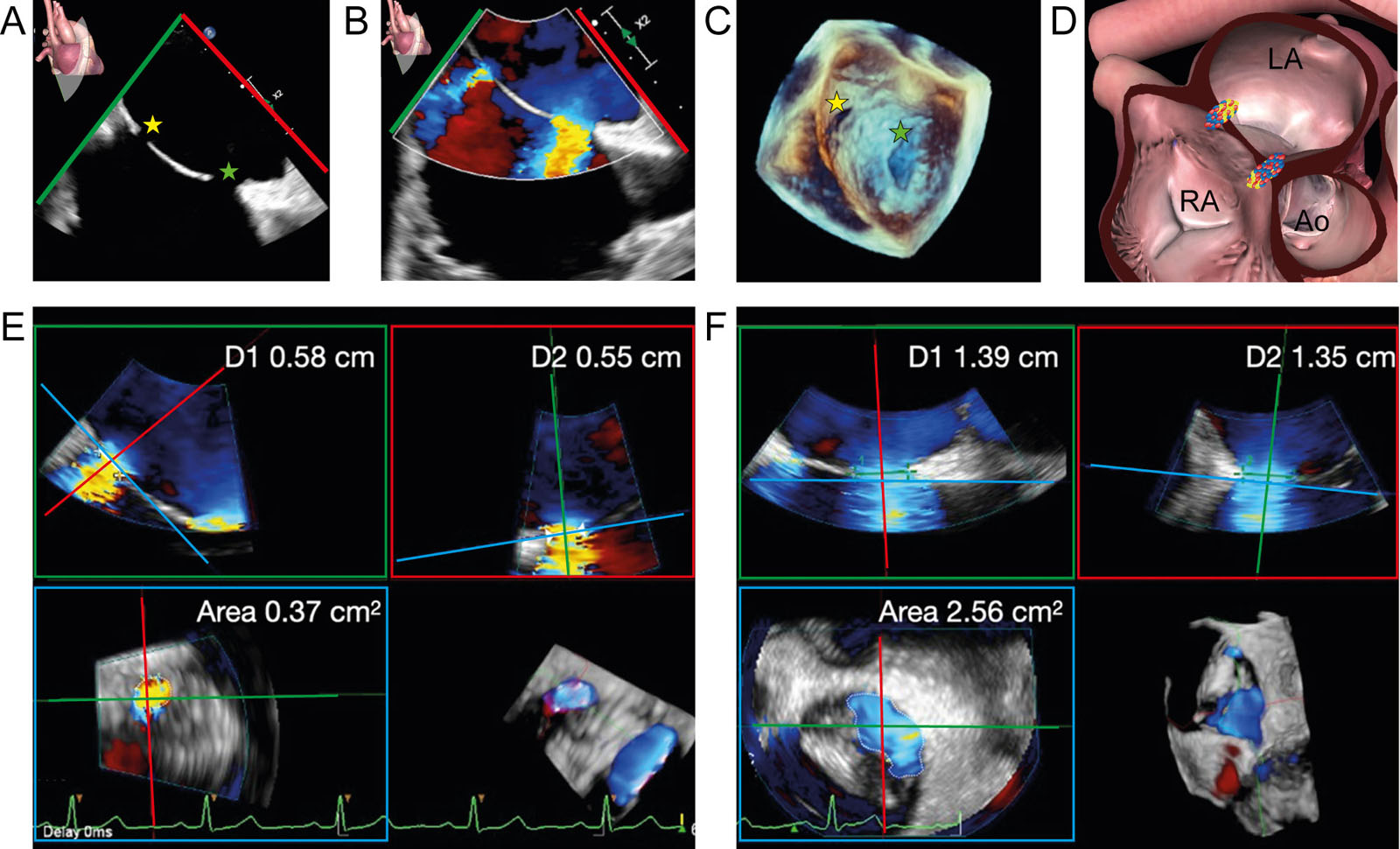 Secundum ASD 3D TEE assessment. (A-D) Zoomed ME bicaval 2D without and with CFI and 3D dataset of the IAS show a secundum ASD (green star) and a smaller, iatrogenic infero-posterior ASD (yellow star) from a previous atrial septostomy for atrial fibrillation ablation. (E, F) Analysis of the 3D dataset using MPR enables measurement of the size of both defects (area and orthogonal diameters, D1 and D2).<em> Abbreviations</em>: 2D, two-dimensional; 3D, three-dimensional; Ao, aorta; ASD, atrial septal defect; CFI, color flow imaging; D, diameter; IAS, interatrial septum; LA, left atrium; ME, mid-esophageal; MPR, multiplanar reconstruction; RA, right atrium; TEE, transesophageal echocardiography.<i class='fa fa-video-camera' aria-hidden='true'></i>