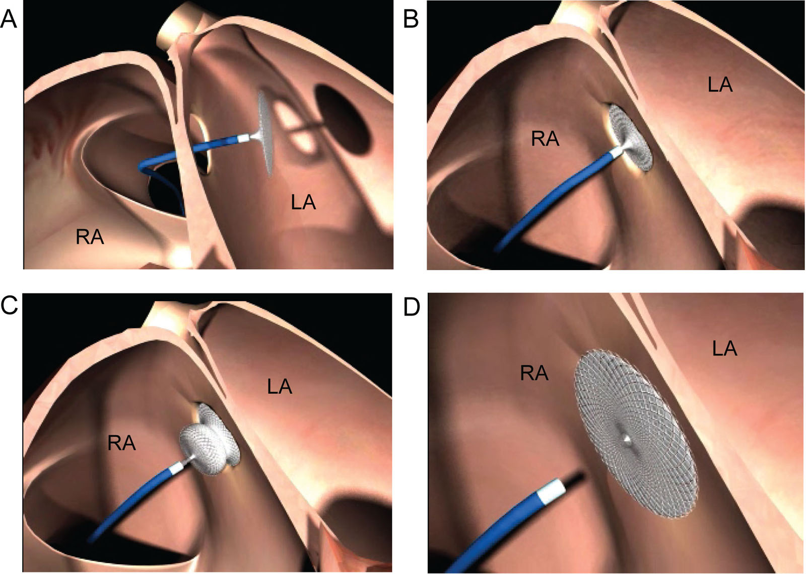 Percutaneous ASD device closure. These diagrams illustrate the sequence of events during a percutaneous Amplatzer<sup>TM</sup> device closure of a secundum ASD. (A) The catheter with the device passes through the ASD from the RA to the LA. (B) The operator deploys the LA disc and pulls it snugly against the LA side of the IAS. (C) The RA disc deploys against the RA side of the IAS. (D) The definitive device release is by unscrewing the cable from it and retrieving both the cable and the delivery sheath.<em> Abbreviations</em>: ASD, atrial septal defect; IAS, interatrial septum; LA, left atrium; RA, right atrium. Source: courtesy of Abbott.<i class='fa fa-video-camera' aria-hidden='true'></i>