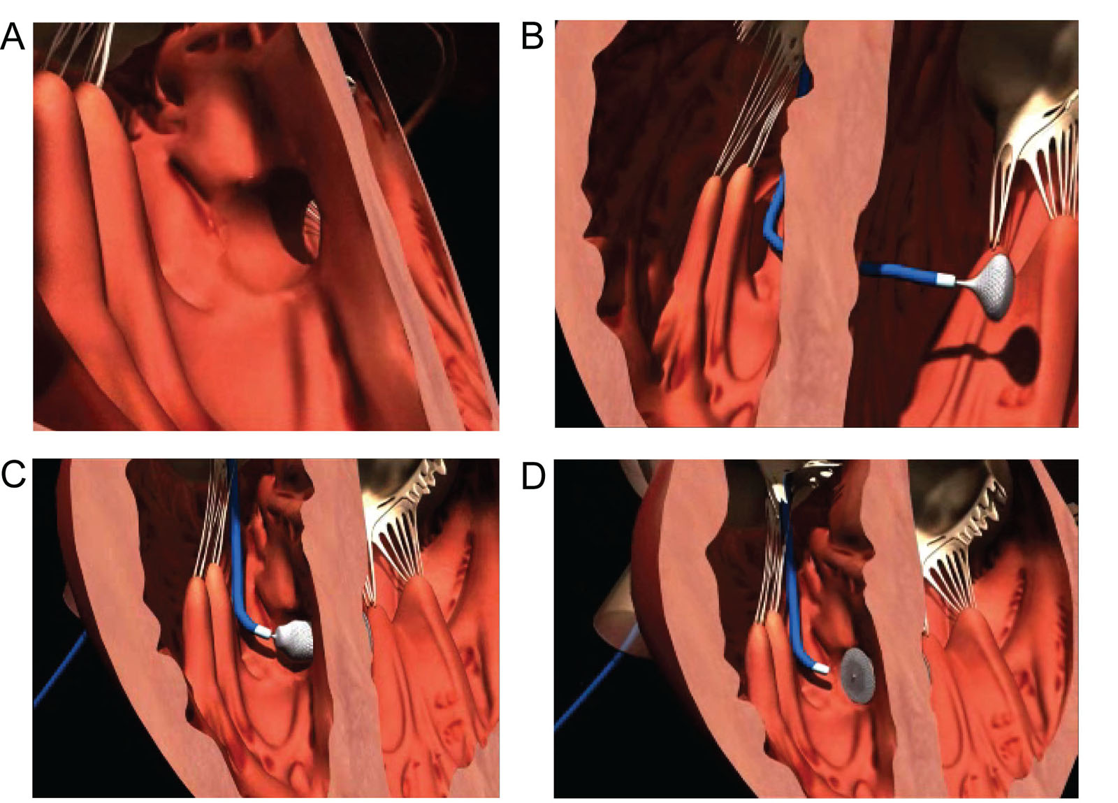 Percutaneous VSD device closure. These diagrams illustrate the sequence of events during a percutaneous Amplatzer<sup>TM</sup> device closure of a muscular VSD. (A) The catheter holding the device passes through the VSD from the RV to the LV. (B) The operator deploys the LV disc and pulls it snugly against the LV side of the IVS. (C) The RV disc deploys against the RV side of the IVS. (D) The introducer cable detaches from the device and is removed with its delivery sheath.<em> Abbreviations</em>: IVS, interventricular septum; LV, left ventricle or left ventricular; RV, right ventricle or right ventricular; VSD, ventricular septal defects. Source: Courtesy of Abbott.<i class='fa fa-video-camera' aria-hidden='true'></i>