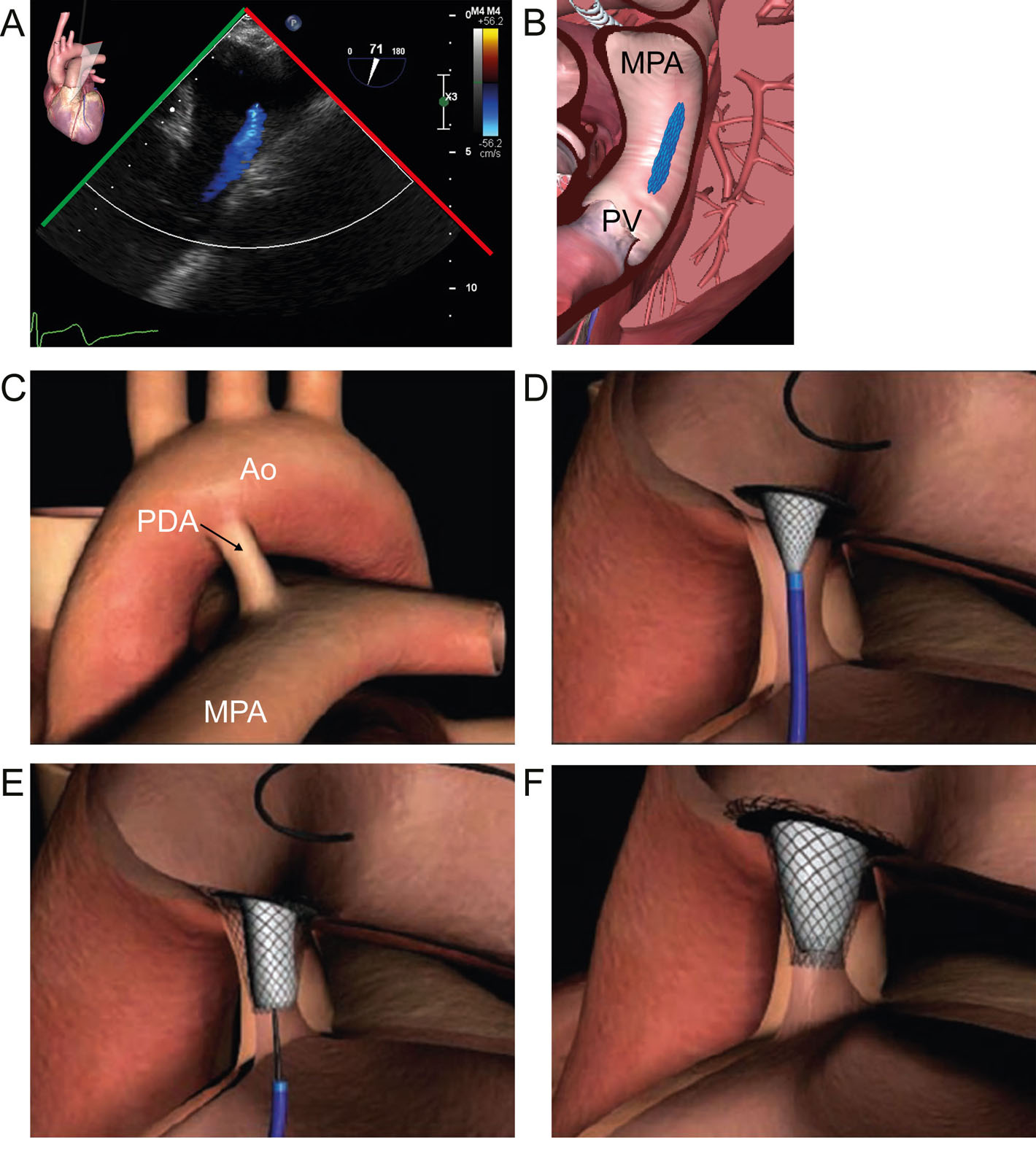 PDA device closure. (A,B) UE view of a PDA. (C-F) These diagrams illustrate the sequence of events during the percutaneous device closure of a PDA. Abbreviation: Ao, aortic valve; MPA, main pulmonary artery; PDA, patent ductus arteriosus; PV, pulmonic valve; UE, upper esophageal. Source: Courtesy of Abbott <i class='fa fa-video-camera' aria-hidden='true'></i>