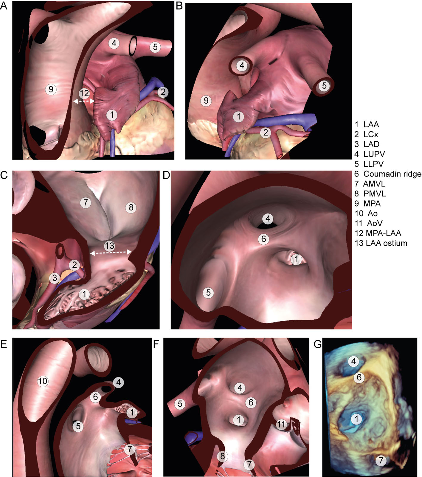 LAA anatomy. The LAA appears from the external perspective (A) anterior and (B) left side and (C) the internal perspective. Note the proximity of the MPA to the LAA. (D-F) These diagrams show the relationship of the LAA to surrounding structures, including the (D) coumadin ridge, (E) PV and (F) with MV. (G) This is a 3D dataset from the LA perspective showing the orifice of the LAA and LUPV.<em> Abbreviations</em>: 3D, three-dimensional; AMVL, anterior mitral valve leaflet; Ao, aorta; AoV, aortic valve; LA, left atrium; LAA, left atrial appendage; LAD, left anterior descending artery; LCx <s>where</s>, left circumflex artery; LLPV where, left lower pulmonary vein; LUPV where, left upper pulmonary vein; MPA, main pulmonary artery; MV, mitral valve; PMVL, posterior mitral valve leaflet; PV, pulmonic valve.<i class='fa fa-video-camera' aria-hidden='true'></i>