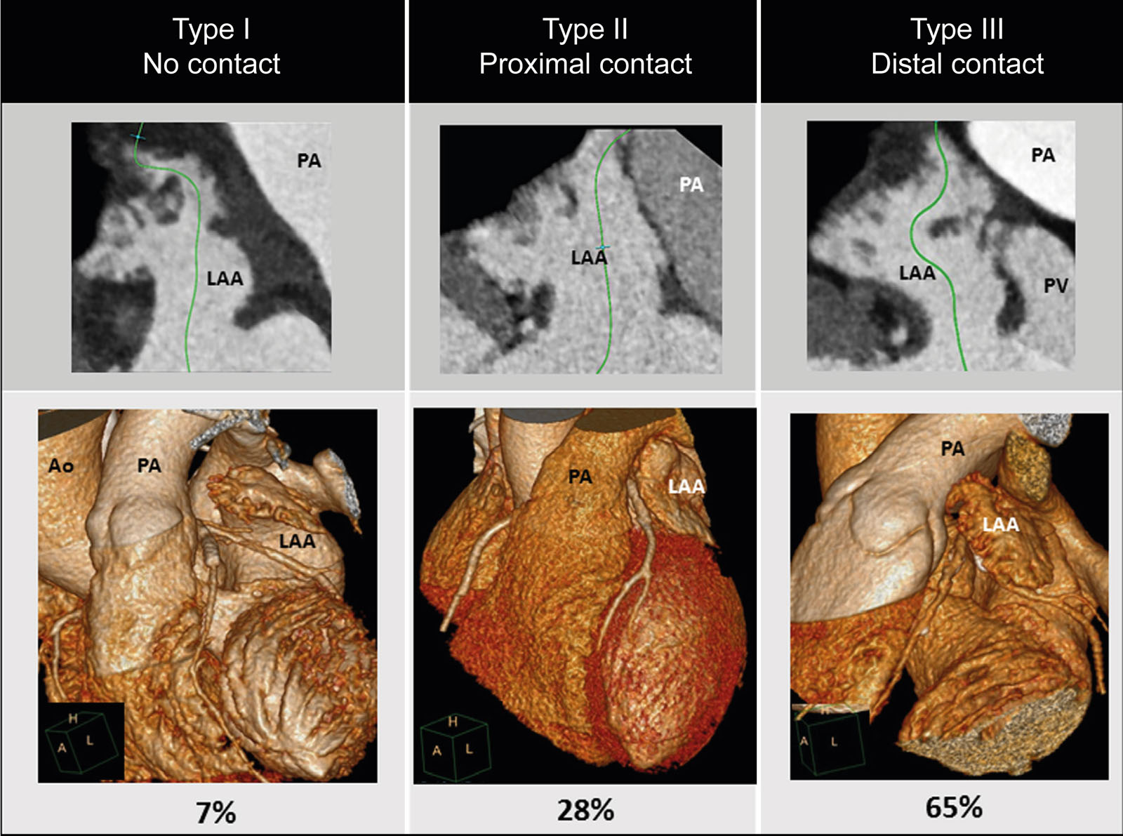 LAA-PA relationships. These 3D CT reconstructions and diagrams show the prevalence and types of anatomic relationships between the LAA and PA. Type 1 is complete separation between the LAA and the PA. Type 2 involves contact between the proximal PA and Type 3 is contact between the distal PA. The risk of perforation is greater with the Amulet.<em> Abbreviations</em>: Ao, aorta; CT, computed tomography; LAA, left atrial appendage; PA, pulmonary artery; PV; pulmonary vein. Source: Halkin A, et al.<strong><sup>75</sup></strong>