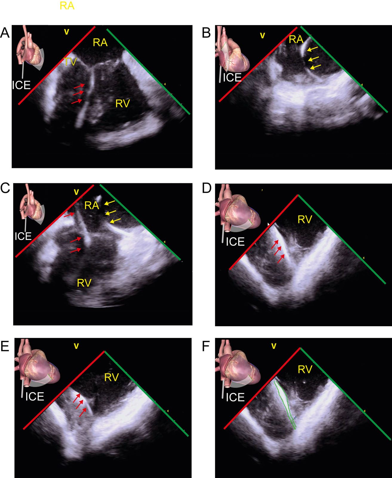 ICE clinical examples. These are ICE images in a patient with a dual-chamber pacemaker, including (A-C) ICE RA views showing the RV lead (red arrows) and RA lead (yellow arrows), and the (D,E) ICE RV views. (F) The leads can be “drawn” on the ICE image (green lines) and imported into the 3D navigation system to minimize the risk of lead dislodgement during catheter manipulation.<em> Abbreviations</em>: 3D, three-dimensional; ICE, intracardiac echocardiography; RA, right atrium; RV, right ventricle; TV, tricuspid valve.