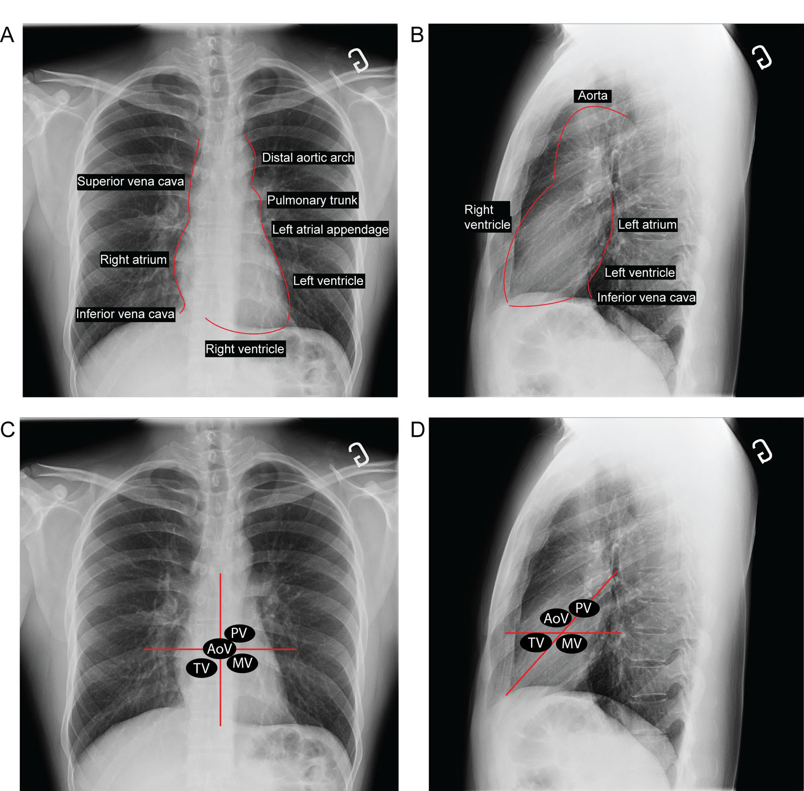 Heart borders on CXRs. (A, B) A normal CXR demonstrates the different heart borders on the (A) frontal and (B) lateral views. The curvature of the LAA is not visible unless there is dilatation of the LAA and/or the LA. (C, D) These CXRs show the locations of the heart valve location. A frontal film with imaginary lines (red lines) drawn vertically at the sternum and perpendicularly through the midpoint of the heart shows the estimated location of each valve. A lateral film with an imaginary line (red line) drawn from the cardiac apex to the carina and a second line (red line) perpendicular to the sternum through the midpoint of the heart shows the estimated location of each valve.<em> Abbreviations</em>: AoV, aortic valve; CXR, chest X-ray; LA, left atrium; LAA, left atrial appendage; MV, mitral valve; PV, pulmonic valve; TV, tricuspid valve.