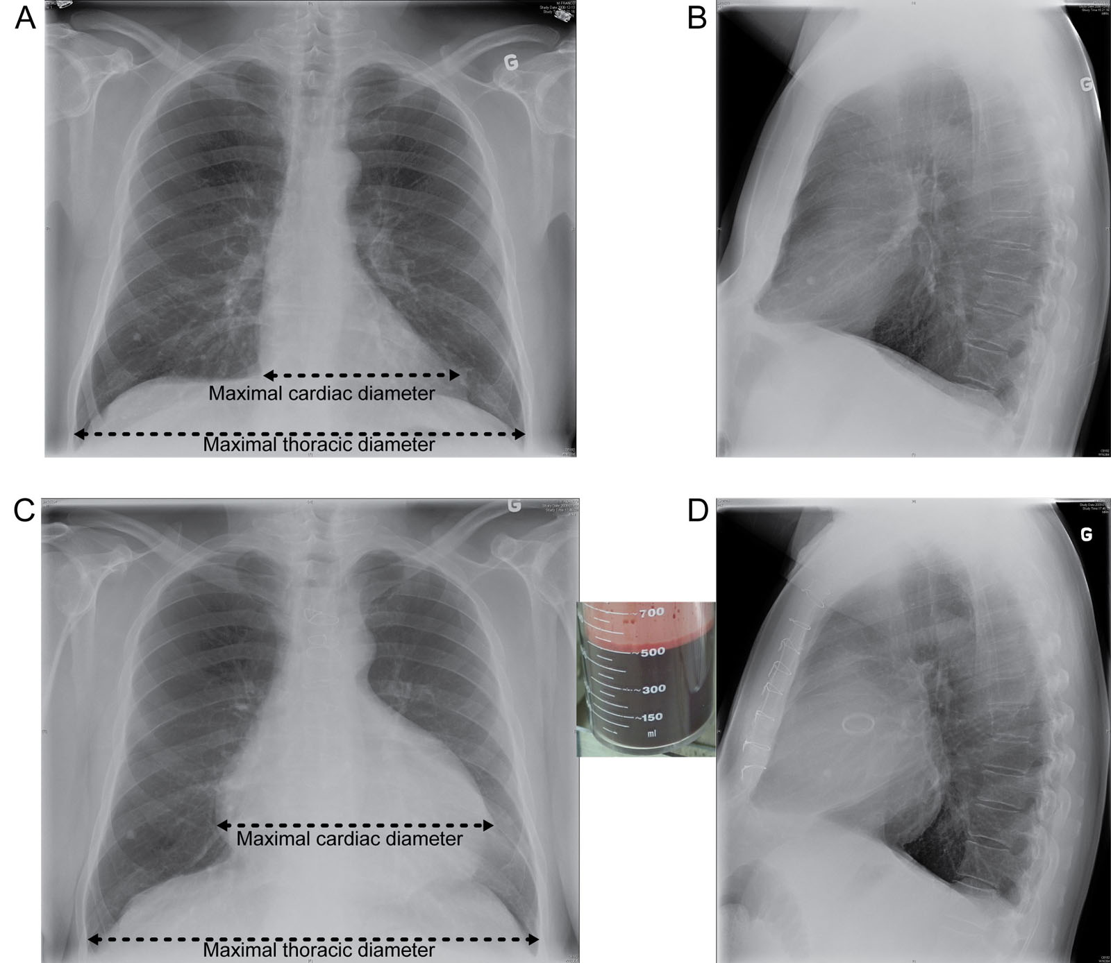 Cardiothoracic ratio. This is a 66-year-old male before AVR. (A, B) Frontal and lateral CXRs depict a normal cardiothoracic ratio of less than 0.5, as calculated from the ratio of the maximal cardiac diameter (top black line) to the maximal thoracic diameter (bottom black line). (C, D) Postoperative tamponade is present with an increased cardiothoracic ratio in both the frontal and lateral chest radiographs. There was a removal of 500 mL of pericardial fluid. Abbreviation: AVR, aortic valve replacement; CXR, chest X-ray.