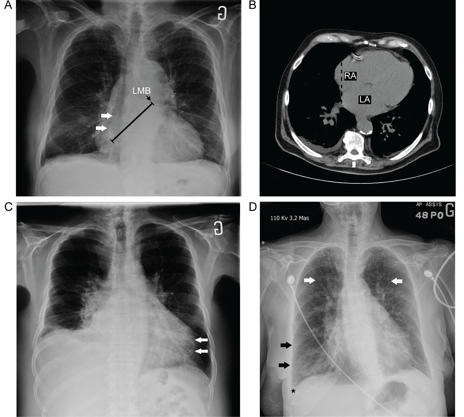 Abnormal CXR. (A, B) These examples of CXRs show enlargement of the heart chambers. (A) Frontal CXR with LA enlargement depicts the double density sign, where the right border of an enlarged LA (arrows) appears near the normal right heart border. A measurement taken from the right lateral border of the LA to the inferior border of the left main bronchus (black line) is > 7 cm, suggesting LA enlargement. (B) Unenhanced axial CT image of the same patient shows the right border of the enlarged LA displaced towards the right, creating a second density (dashed black lines) behind the RA. (C) A frontal CXR of a patient with previous infarction shows myocardial calcifications of the LV (arrows) within the heart silhouette and a small right pleural effusion. (D) Frontal CXR of a patient with cardiomegaly depicts apical redistribution of pulmonary vasculature (white arrows), thickened interlobular septa (black arrows), and a small right pleural effusion (black star), all signs indicating pulmonary edema.<em> Abbreviations</em>: CT, computed tomography; CXR, chest X-ray; LA, left atrium; LMB, left main bronchus; LV, left ventricle; RA, right atrium.