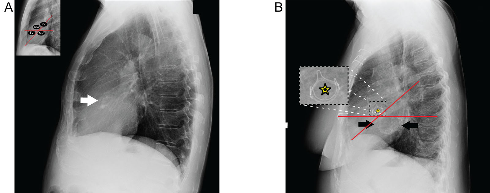 Valve calcifications. (A) A lateral CXR of a 55-year-old male with severe AoV stenosis requiring valve replacement surgery depicts important aortic calcifications (arrow). (B) A lateral CXR of a 74-year-old female with a previous AoV replacement (star) shows MV annulus calcifications (black arrows).<em> Abbreviations</em>: AoV, aortic valve; CXR, chest X-ray; MV, mitral valve; PV, pulmonic valve; TV, tricuspid valve.