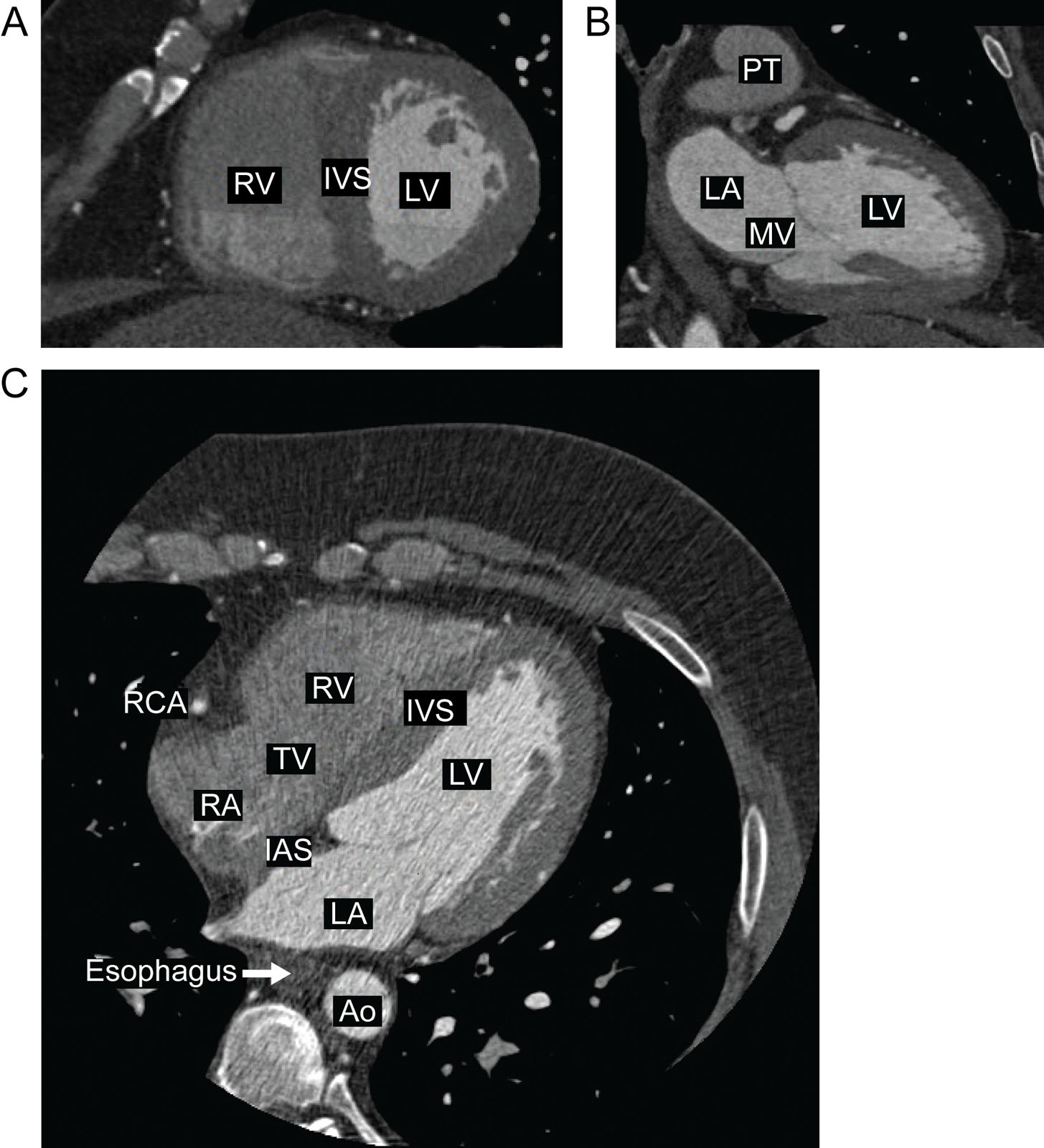 Normal anatomy on CCT. (A) CCT SAX view shows the IVS, LV, RV and allows evaluation of myocardial thickness. (B) CCT LAX or 2C view depicts the LA and LV. (C) CCT 4C view allows the general evaluation of cardiac valves and all four cardiac chambers.<em> Abbreviations</em>: 2C, two-chamber; 4C, four-chamber; Ao, aorta; CCT, cardiac computed tomography; IAS, interatrial septum; IVS, interventricular septum; LA, left atrium; LAX, long-axis; LV, left ventricle; MV, mitral valve; PT, pulmonary trunk; RA, right atrium; RCA, right coronary artery; RV, right ventricle; SAX, short-axis; TV, tricuspid valve.