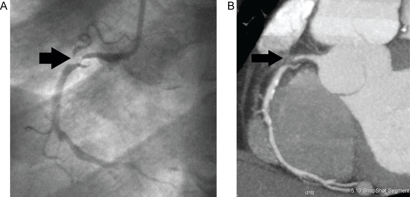 CCTA. (A) Conventional catheter angiography on a 64-year-old male with coronary disease identifies severe stenosis of the proximal RCA (black arrow). (B) CCTA of the same patient assesses the coronary walls and lumen, which show extensive atheromatous disease with a low-density plaque, causing severe subtotal stenosis of the proximal RCA (black arrow).<em> Abbreviations</em>: CCTA, coronary computed tomography angiography; RCA, right coronary. Source: Reproduced with permission from Bordeleau et al.<sup>12</sup>