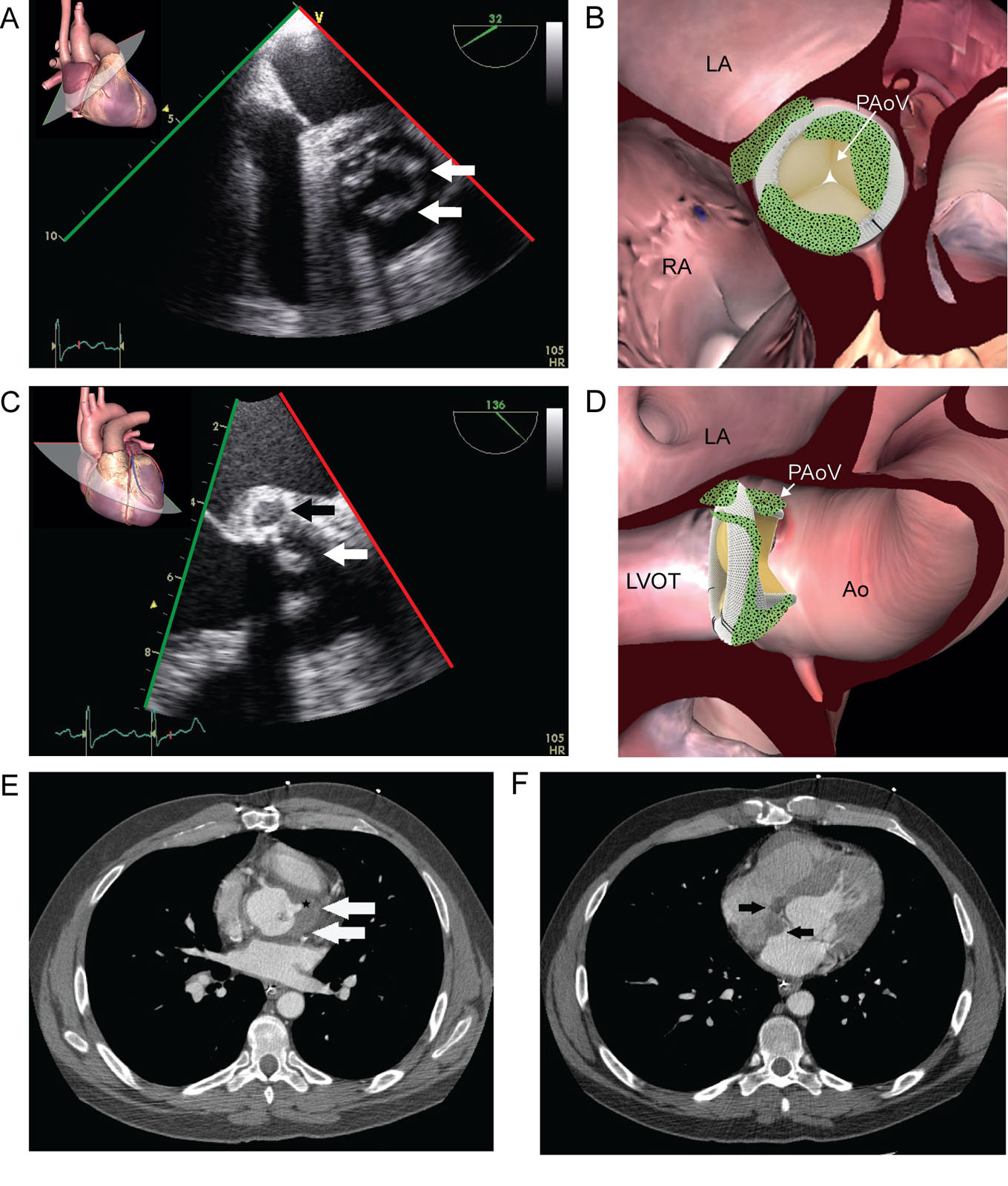 Endocarditis and perivalvular abscess. (A, B) TEE ME AoV SAX view of a 44-year-old male with a previous bioprosthetic AoV replacement shows thickened and irregular valve cusps (white arrows) suggestive of endocarditis. (C, D) TEE ME AoV LAX shows thickening in the posterior aortic root with a less dense central area (black arrow) consistent with an abscess. (E) CCT images of the same patient detect the anterior portion of the perivalvular abscess (white arrows) seen as an adjacent hypodense collection with faint wall enhancement. There is also a blunt tract (black star), that has not yet fistulized, and (F) the involvement of the interatrial septum (black arrows).<em> Abbreviations</em>: Ao, aorta; AoV, aortic valve; CCT, cardiac computed tomography; LA, left atrium; LAX, long-axis; LVOT, left ventricular outflow tract; ME, mid-esophageal; PAoV, prosthetic aortic valve; RA, right atrium; SAX, short-axis; TEE, transesophageal echocardiography.