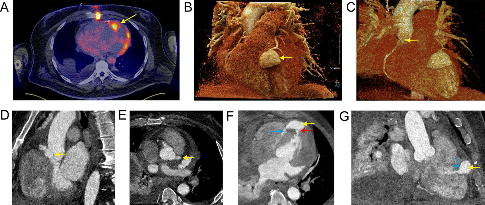 Mycotic aneurysm imaging. (A) Axial slice of fused PET and CT scan shows the abnormal uptake at the end of the LAD coronary, representing the mycotic aneurysm (yellow arrow). Additional uptake of the LV lateral wall and at the sternum is present. (B-E) CCT angiography with prospective E<strong>C</strong>G-gating and intravenous contrast (iopamidol 370) in arterial phase. The yellow arrow indicates a 3D volume rendering and 2D of the (B) LAD, (C, D) RCA and (E) left main mycotic aneurysms. (F, G) The red arrow indicates the fistula to the LV and the blue arrow, the fistula to the RV.<em> Abbreviations</em>: 2D, two-dimensional; 3D, three-dimensional; CCT, cardiac computed tomography; CT, computed tomography; E<strong>C</strong>G, electrocardiographic; LAD, left anterior descending; LV, left ventricle; PET, positron emission tomography; RCA, right coronary artery; RV, right ventricle. Adapted from Ogondon et al. <sup>56</sup> <i class='fa fa-video-camera' aria-hidden='true'></i>