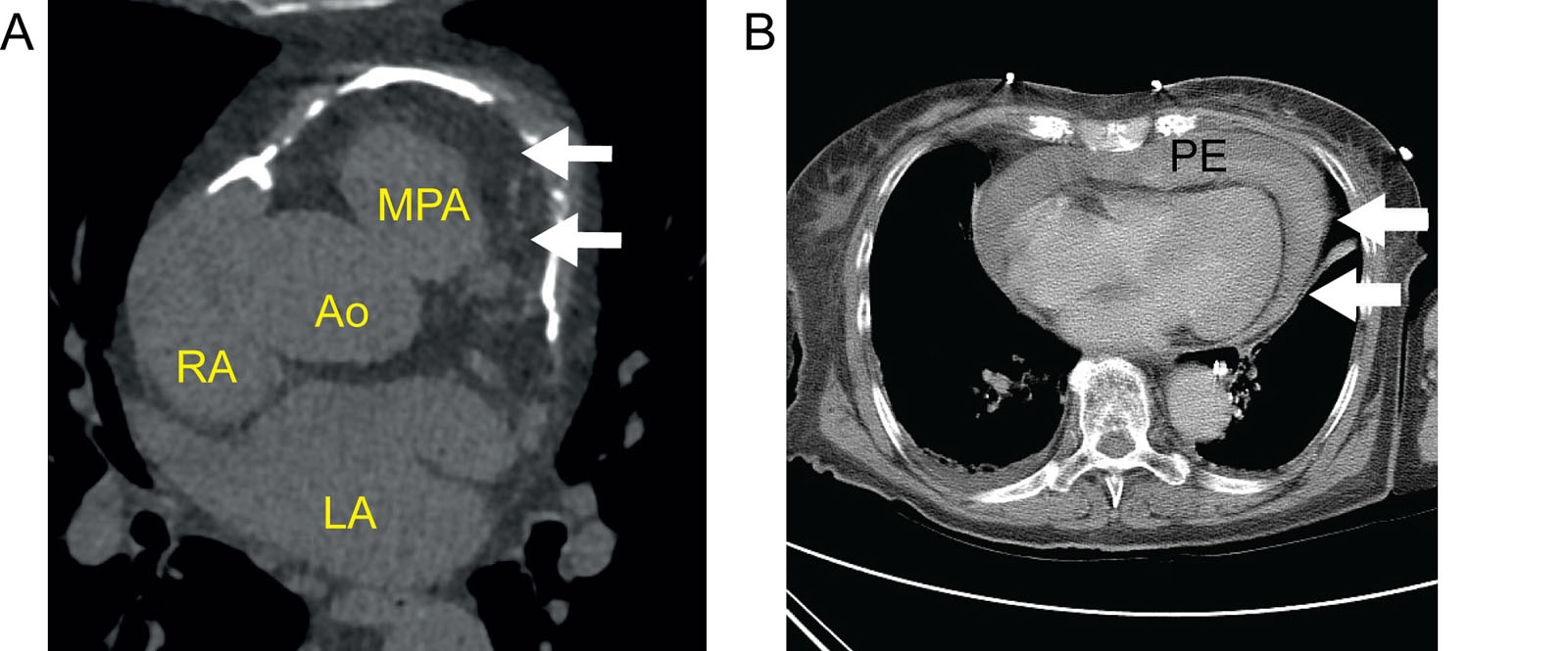 Pericardial effusion. (A) Axial CT view of the upper portion of the heart showing anterior pericardial calcification in a patient with constrictive pericarditis. (B) Axial contrast-enhanced CT of a 90-year-old female presenting with chest pain depicts a moderate PE with high attenuation (white arrows), indicating a hemorrhagic effusion.<em> Abbreviations</em>: Ao, aorta; CT, computed tomography; LA, Left atrium; MPA, main pulmonary artery; PE, pericardial effusion; RA, right atrium.