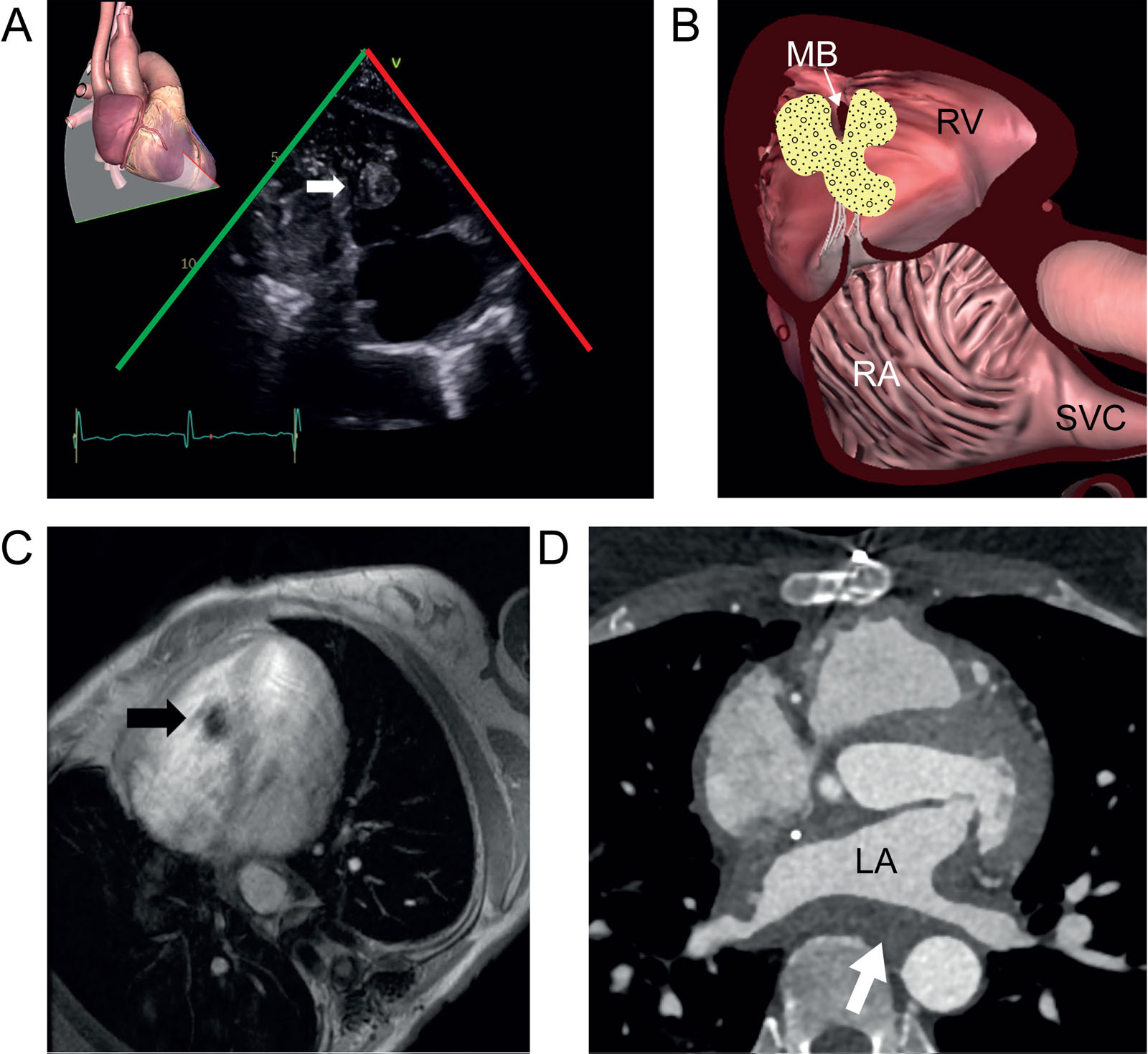 Endocavitary metastasis. (A, B) TTE subcostal RV 2C view of a 72-year-old female known for a colorectal cancer shows one of many endocavitary RV masses (white arrow). (C) Cardiac MRI of the same patient confirms a triangular, irregular hypointense lesion next to the moderator band (black arrow) corresponding to a metastasis. (D) LA sarcoma associated with wall thickening from myocardium invasion.<em> Abbreviations</em>: 2C, two-chamber; LA, left atrium; MB, moderator band; MRI, magnetic resonance imaging; RA, right atrium; RV, right ventricular; SVC, superior vena cava; TTE, transthoracic echocardiography.