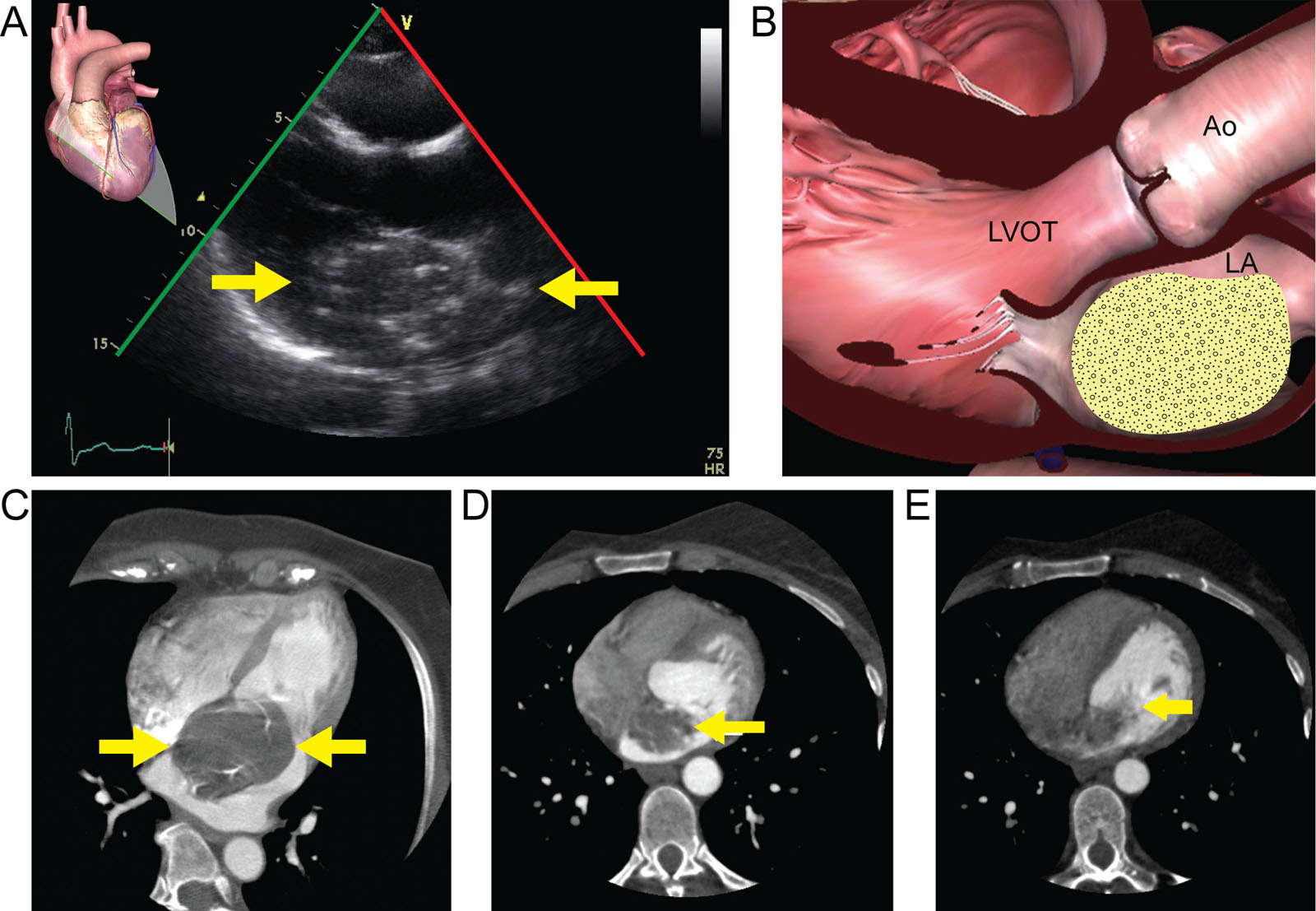 Myxoma. (A, B) TTE of a 62-year-old female shows a hyper-echoic mass (white arrows) with punctuate calcifications in the LA. (C) CCT of the same patient depicts the hypodense mass (white arrow) with calcifications, which was an LA myxoma. Note that the mass is in contract with the IAS, which is an imaging sign highly specific for myxoma, as most atrial myxomas attach here. (D) CCT of a 45-year-old female shows a hypo enhancing LA mass (white arrow) that has a sessile attachment to the IAS. (E) Same CCT exam showing the prolapse of the mass through the MV (white arrow).<em> Abbreviations</em>: Ao, aorta; CCT, cardiac computed tomography; IAS, interatrial septum; LA, left atrium; LVOT, left ventricular outflow tract; MV, mitral valve; TTE, transthoracic echocardiography.
