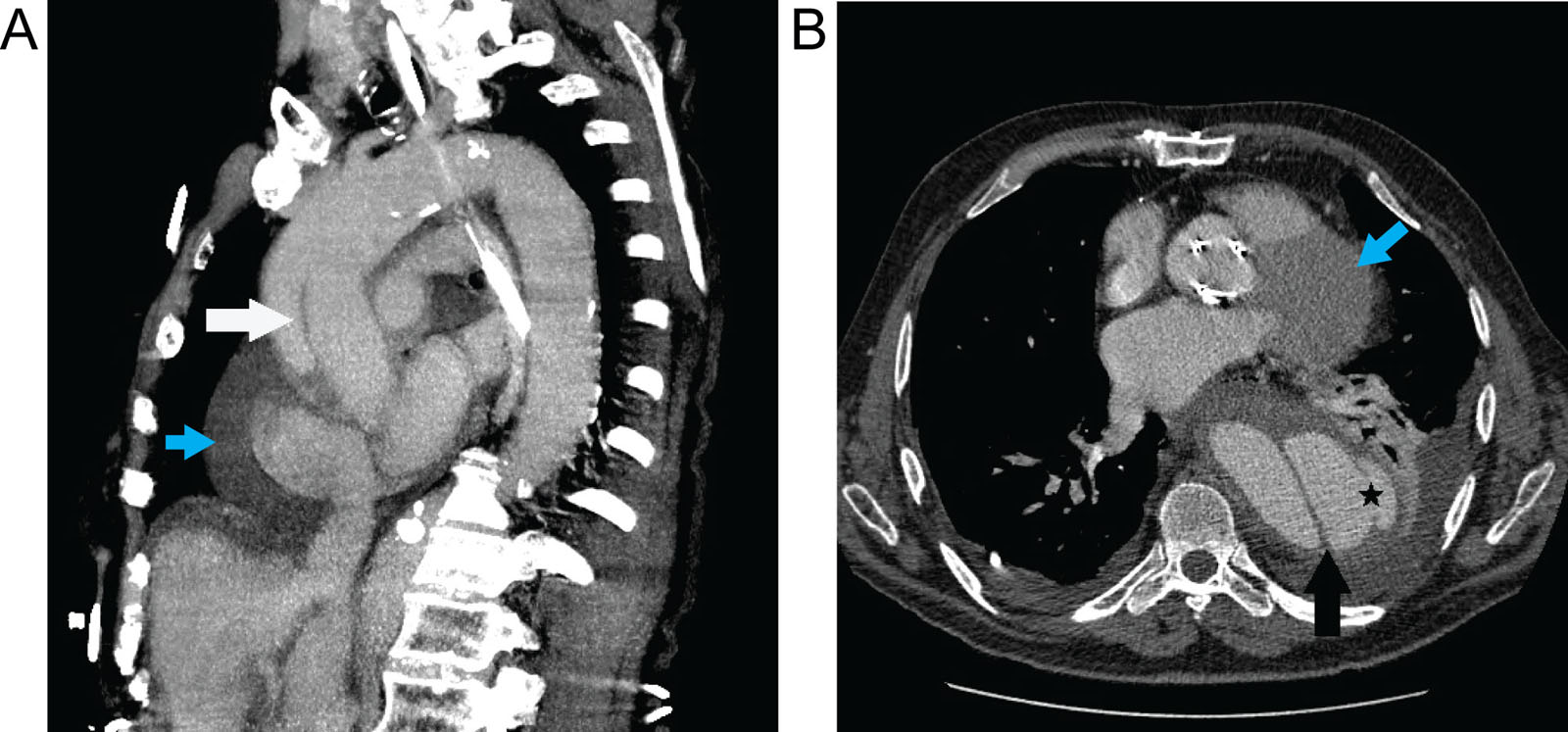 Aortic dissection. (A) CCT images of a 78-year-old male with acute chest pain depict thoracic aortic dissection (white arrow in a sagittal image), (B) that appears ruptured (black star) with an associated PE (blue arrows) and a left pleural effusion.<em> Abbreviations</em>: CCT, cardiac computed tomography; PE, pericardial effusion.