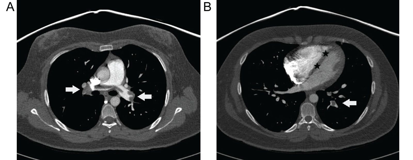 Pulmonary embolism. (A) Pulmonary CT angiography axial images of a 30-year-old female presenting with acute chest pain demonstrate central pulmonary emboli, or “saddle emboli” in the main pulmonary arteries (white arrows). (B) A straight IVS (black stars) suggests RV overload.<em> Abbreviations</em>: CT, computed tomography; IVS, interventricular septum; RV, right ventricular.