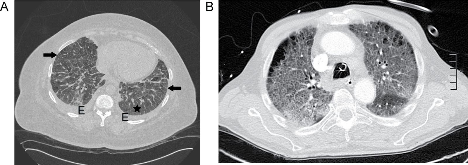 Pulmonary edema and fibrosis. (A) CCT axial images of a 49-year-old female with acute dyspnea show thickened interlobular septa (black arrows), ground-glass opacities (black star), and bilateral small pleural effusions indicating pulmonary edema. (B) Pulmonary CT showing pulmonary fibrosis without a pleural effusion in a 63-year-old male.<em> Abbreviations</em>: CCT, cardiac computed tomography; CT, computed tomography; E, effusion.