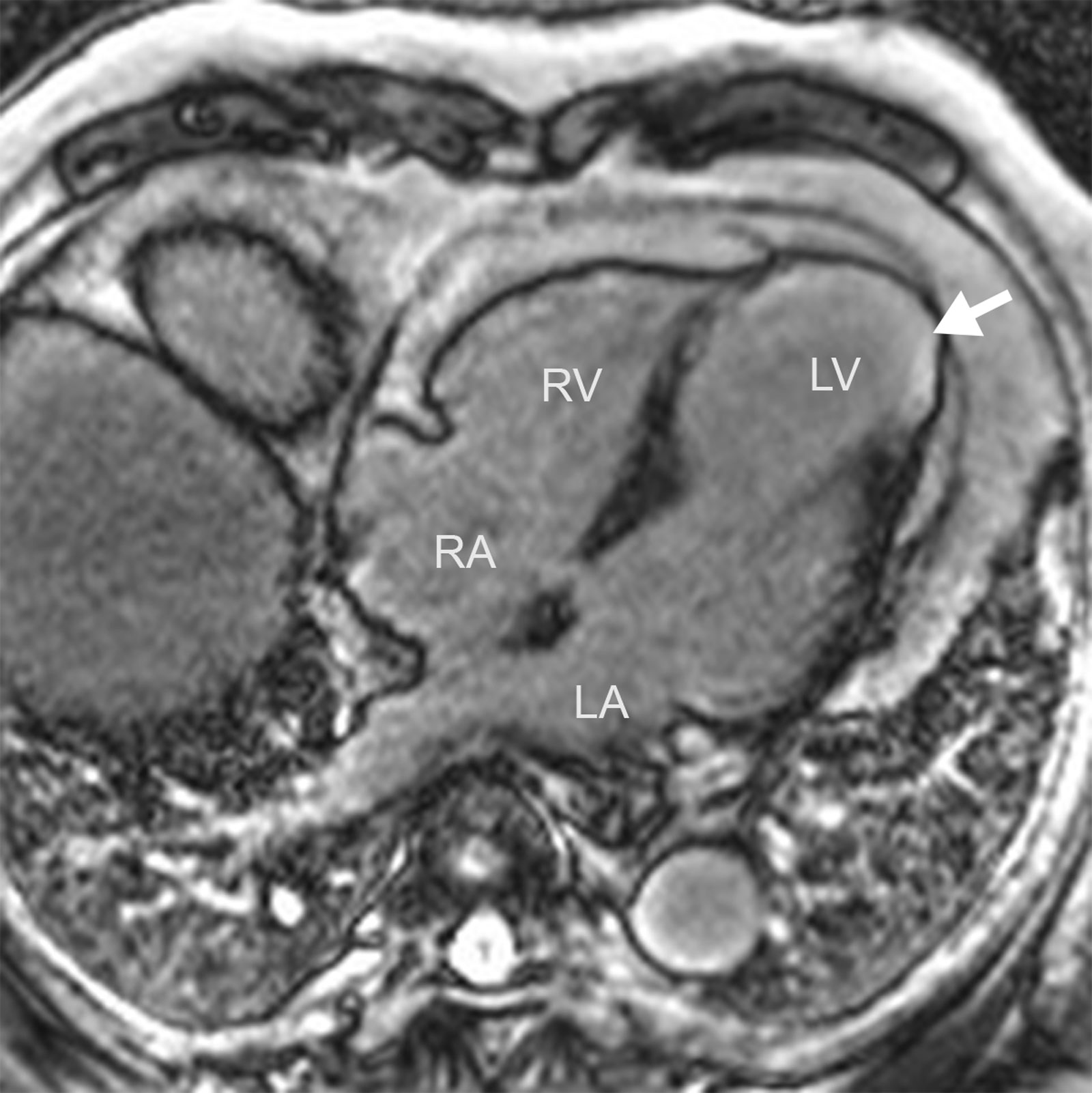 Myocardial ischemia. MRI 4C view shows apical transmural late gadolinium enhancement (arrow) with an aneurysmal dilation typical of LAD territory infarct. Abbreviation: 4C, four-chamber; LA, left atrium; LAD, left anterior descending; LV, left ventricle; MRI, magnetic resonance imaging; RA, right atrium; RV, right ventricle.