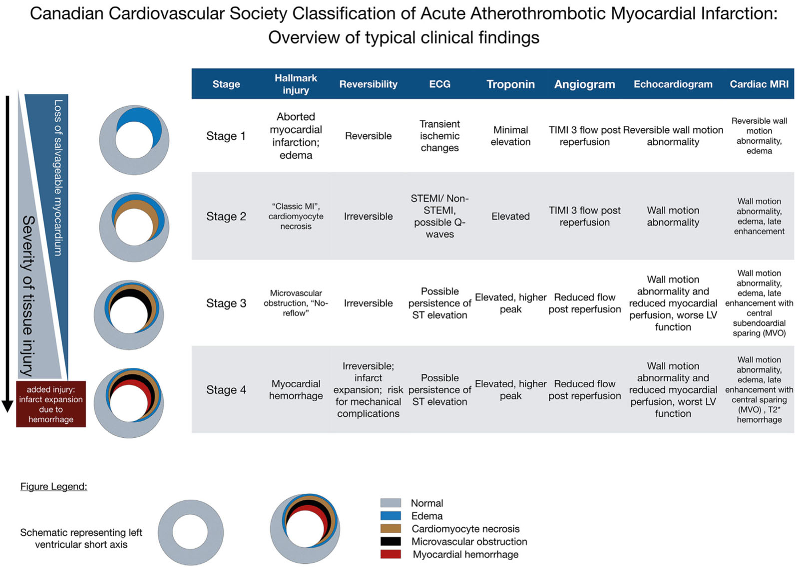 Overview of typical clinical findings at each stage of the CCS classification of acute atherothrombotic myocardial infarction (CCS-AMI). Typical changes are shown; precise diagnostic criteria will require further research and expert consensus. The stages build on each other, reflecting progression of the severity of tissue injury. Timely reperfusion can halt tissue injury at an earlier stage and prevent progression to a more severe stage of injury. Hemorrhagic infarction is the worst stage, can cause infarct expansion, and is associated with mechanical complications. Wall motion abnormalities and electrocardiogram (ECG) changes also depend on the size of the affected myocardium.<em> Abbreviations</em>: CCS-AMI, Canadian Cardiovascular Society Classification of Acute Atherothrombotic Myocardial Infarction; LV, left ventricle; MI, myocardial infarction; MRI, magnetic resonance imaging; MVO, microvascular obstruction; STEMI, ST-elevation myocardial infarction; TIMI, Thrombolysis In Myocardial Infarction. With permission from Kumar et al. <strong><sup>38</sup></strong>