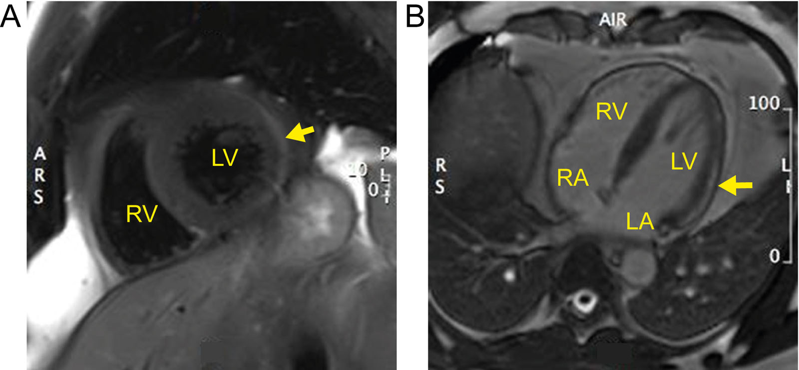 Myocarditis. (A) Spectral attenuated inversion recovery (SPAIR) t2-weighted imaging shows edema over the lateral wall in a patient with viral myocarditis. (B) Sub-epicardial late gadolinium enhancement within the LV lateral wall (arrow) in a patient with viral myocarditis.<em> Abbreviations</em>: ARS, anterior right side; L, left; LA, left atrium; LV, left ventricular; PL, posterior left; RA, right atrium; RS, right side; RV, right ventricle.
