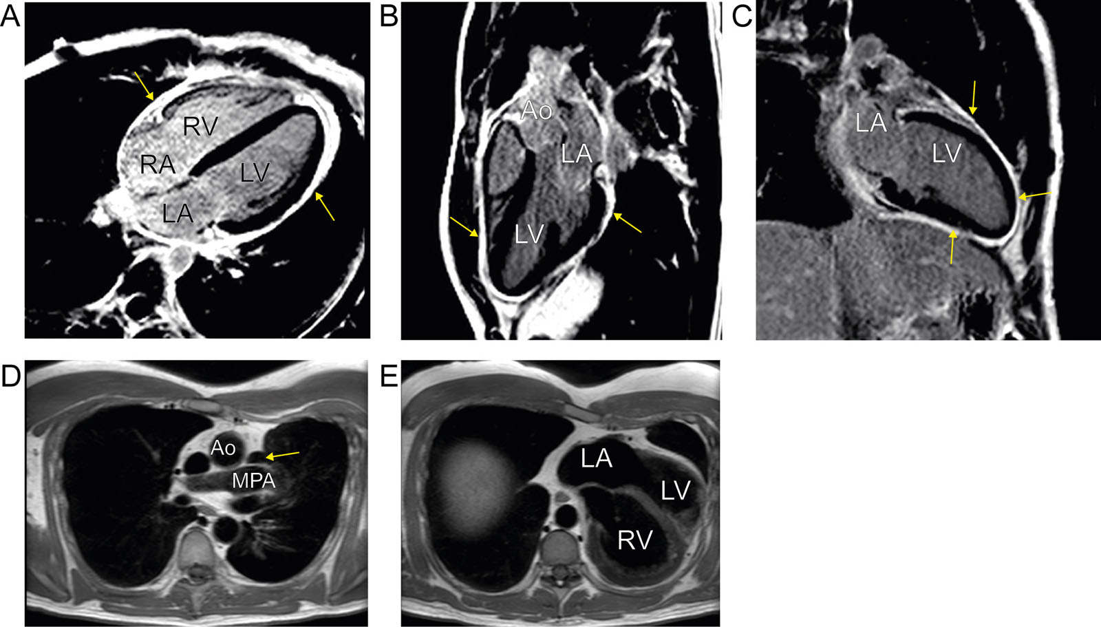 Pericardial abnormalities. (A-C) MRI views showing diffuse pericardial circumferential thickening (arrow) and enhancement in a patient with recurrent pericarditis. (D) Congenital absence of a pericardium. Note the appearance of lung (arrow) between the Ao and the MPA. (E) Axial black blood sequence. There is levocardia related to partial agenesis of the pericardium. Abbreviation: Ao, aorta; LA, left atrium; LV, left ventricle; MPA, main pulmonary artery; MRI, magnetic resonance imaging; RA, right atrium; RV, right ventricle.