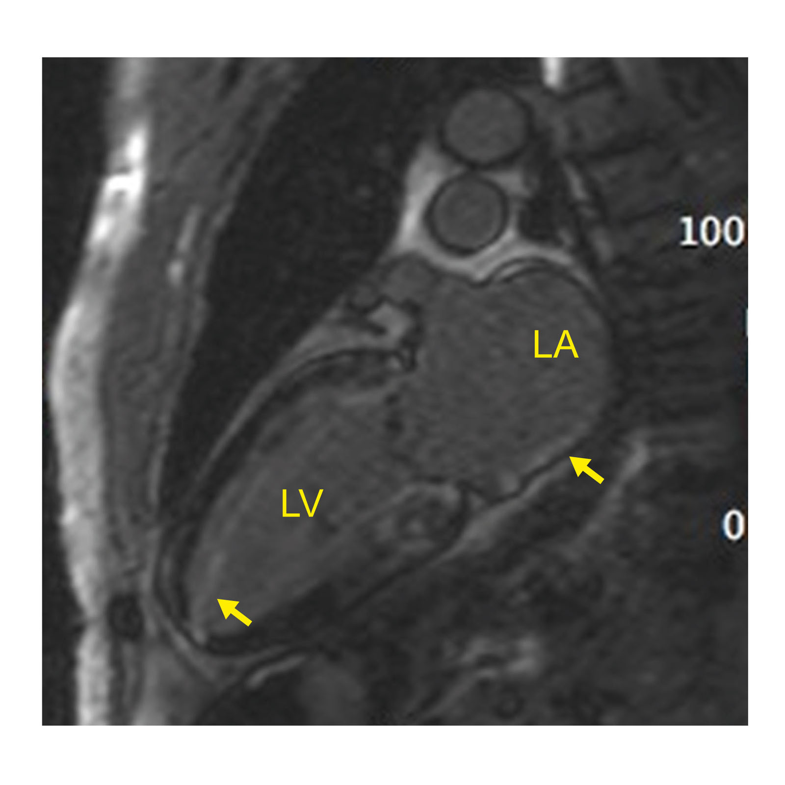 Amyloidosis. MRI with diffuse late gadolinium enhancement in a patient with cardiac amyloidosis. Atrial wall late gadolinium enhancement also appears. Abbreviation: LA, left atrium; LV, left ventricle; MRI, magnetic resonance imaging.