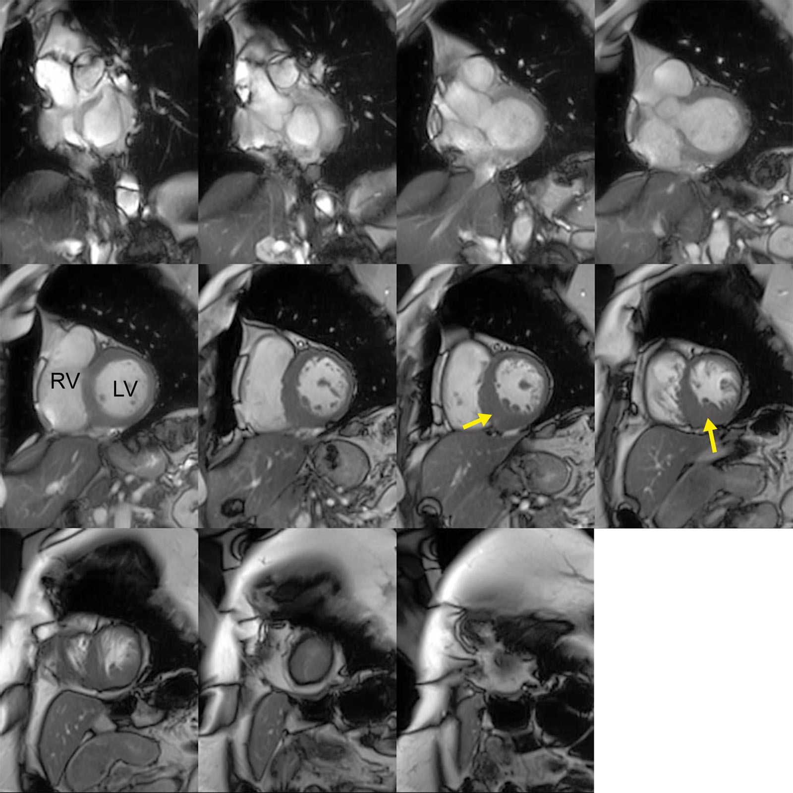 HCM. MRI SAX views in a patient with asymmetric HCM involving predominantly the inferoseptal and inferior wall variant (arrow).<em> Abbreviations</em>: HCM, hypertrophic cardiomyopathy; LV, left ventricle; MRI, magnetic resonance imaging; RV, right ventricle; SAX, short-axis.