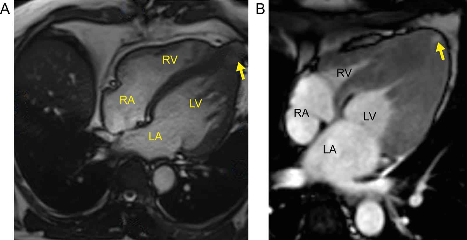 HCM and apical aneurysm. (A, B) MRI showing apical HCM with early (A) LV aneurysm formation (arrow) and (B) a smaller microaneurysm (arrow) using contrast.<em> Abbreviations</em>: HCM hypertrophic cardiomyopathy; LA, left atrium; LV, left ventricular; MRI, magnetic resonance imaging; RA, right atrium; RV, right ventricle.