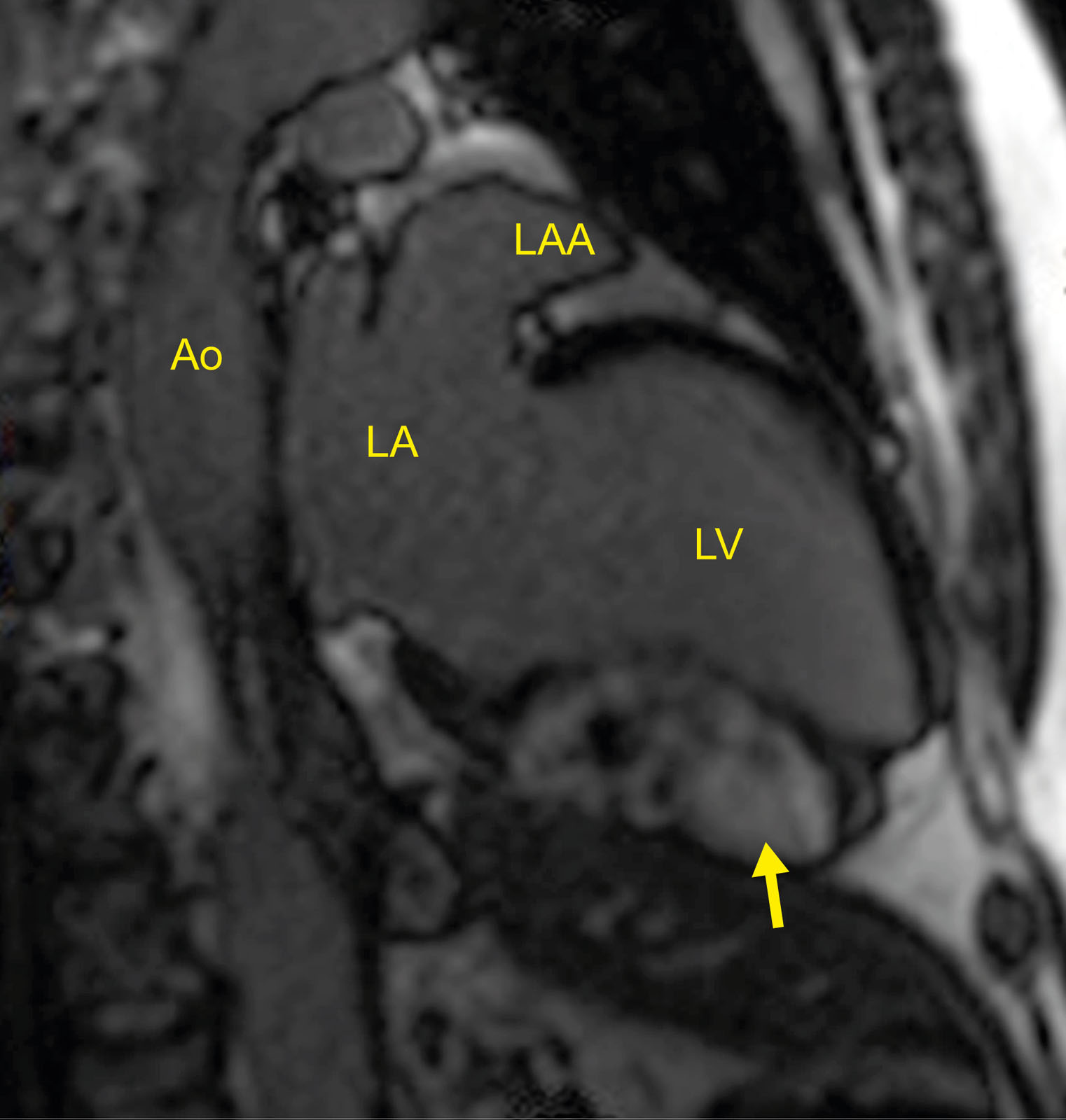 Myocardial fibroma. Sagittal MRI view showing a myocardial fibroma with diffuse late gadolinium enhancement within the inferior LV wall (arrow).<em> Abbreviations</em>: Ao, aorta; LA, left atrium; LAA, left atrial appendage; LV, left ventricular; MRI, magnetic resonance imaging.