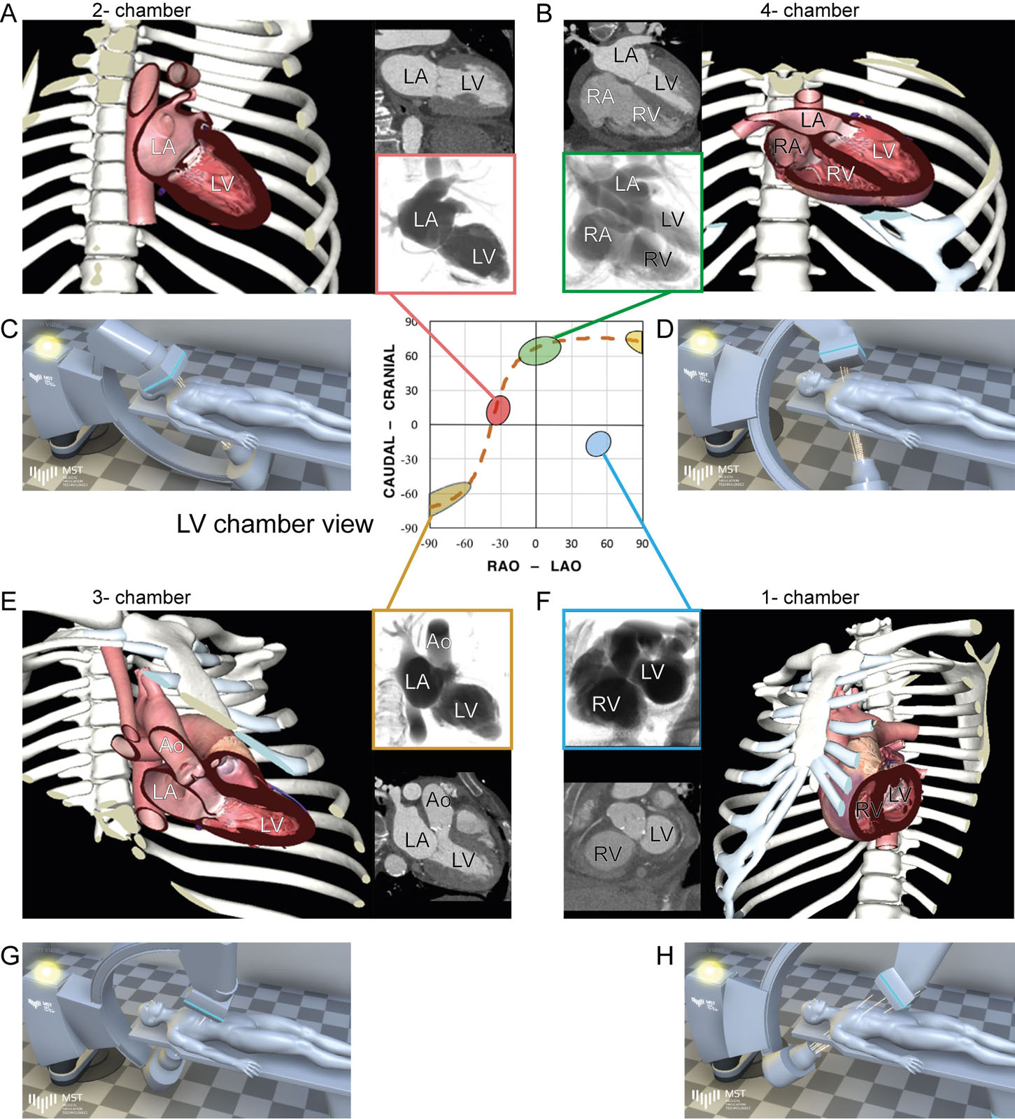 S-curve of the TV annulus showing various LV projections. Fluoroscopic grid integrating LV images, CT chamber view and angiographic chamber views angles from (A) 2C RAO cranial, (B) 4C LAO cranial, (C) 3C RAO caudal and (D) 1C LAO caudal.<em> Abbreviations</em>: 1C, one-chamber; 2C, two-chamber; 3C, three-chamber; 4C, four-chamber; Ao, aorta; CT, computed tomography; LA, left atrium; LAO, left anterior oblique; LV, left ventricular; RA, right atrium; RAO, right anterior oblique RV, right ventricle; TV, tricuspid valve. Adapted from Pighi et al. <sup>54</sup><i class='fa fa-video-camera' aria-hidden='true'></i>