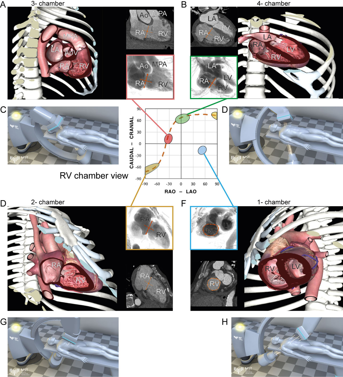 S-curve of the TV annulus showing various RV projections. Fluoroscopic grid integrating RV images, CT chamber views angles and angiographic chamber views angles from (A) 3C RAO cranial, (B) 4C LAO cranial, (C) 2C RAO caudal and (D) 1C LAO caudal.<em> Abbreviations</em>: 1C, one-chamber; 2C, two-chamber; 3C, three-chamber; 4C, four-chamber; Ao, aorta; AoV, aortic valve; CT, computed tomography; LA, left atrium; LAO, left anterior oblique; LV, left ventricular; MPA, main pulmonary artery; RA, right atrium; RAO, right anterior oblique; RV, right ventricle; TV, tricuspid valve. Adapted from Pighi et al. <strong><sup>54</sup></strong>