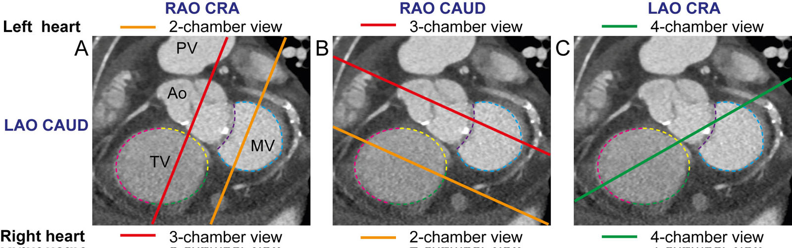 SAX fluoroscopic views of the left and right heart. (A) In RAO cranial, a 2C view is displayed for the left heart but a 3C for the right heart. (B) in RAO caudal, a 3C view is displayed for the left heart but a 2C for the right heart. (C) In LAO cranial, a 4C view displays both left and the right heart.<em>Abbreviations</em>: 2C, two-chamber; 3C, three-chamber; 4C, four-chamber; Ao, aorta; CAUD, caudal; CRA, cranial; LAO, left anterior oblique; MV, mitral valve; PV, pulmonic valve; RAO right anterior oblique; RV, right ventricle; SAX, short-axis; TV, tricuspid valve. Adapted from Pighi et al. <sup>54</sup><i class='fa fa-video-camera' aria-hidden='true'></i>