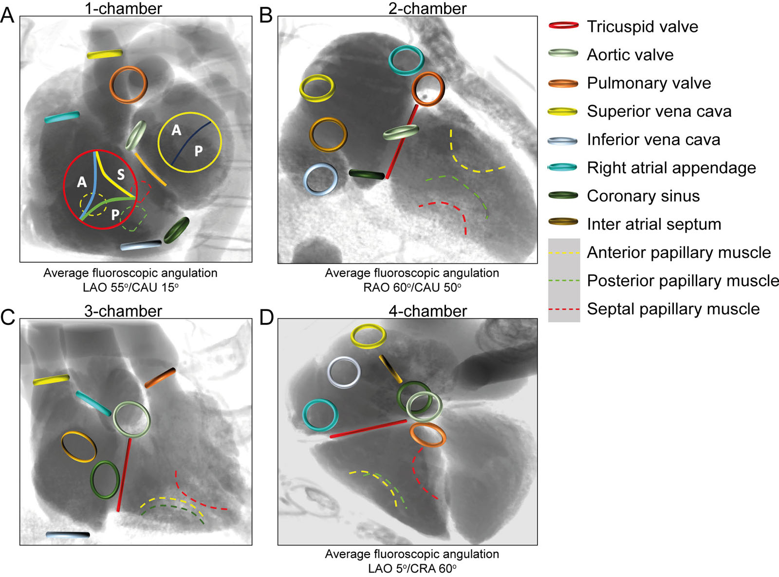 Fluoroscopic RV views with corresponding anatomical structure position from the (A) 1-chamber, (B) 2-chamber, (C) 3-chamber and (D) 4-chamber.<em>Abbreviations</em>: A, anterior; CAUD, caudal; CRA, cranial; LAO, left anterior oblique; P, posterior; RAO, right anterior oblique; S, septal. Courtesy of Dr. Nicolo Piazza.