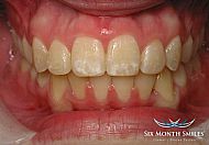 After Six Month Smiles treatment