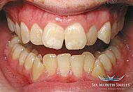 Before Six Month Smiles treatment