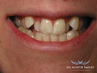 Before Six Month Smiles treatment