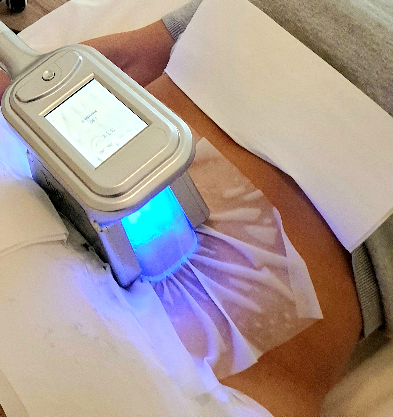 Kryolipolyse ( Coolsculpting ) statt Fettabsaugen - Fettabsaugung Potsdam / Berlin - Zehlendorf / Wannsee / Brandenburg, Charlottenstraße in Potsdam