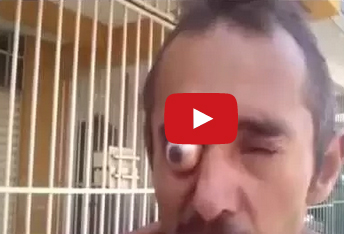 فيديو |  شخص بإخراج عينه وإدخالها