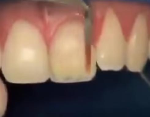 بالفيديو.. طريقة تصليح سن مكسور دون خلعه بالفيديو.. طريقة تصليح سن مكسور دون خلعه