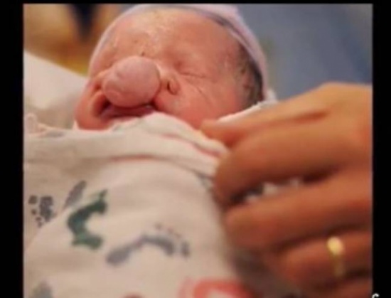 صور| هذه الطفلة ولدت دون أي أمل بالعيش!