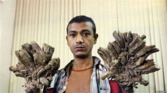 بالصور: "الرجل الشجرة" يستعيد يديه وحياته