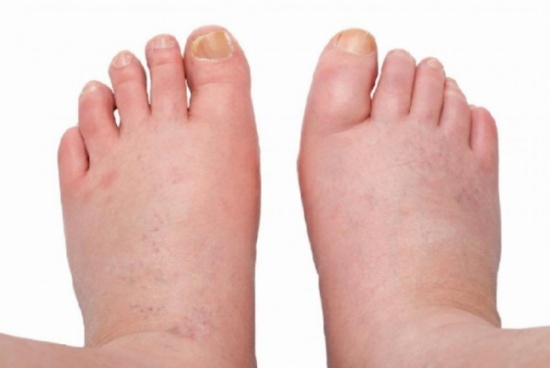 هذا ما يجب أن تأكلوه لتمنعوا احتباس الماء في أقدامكم