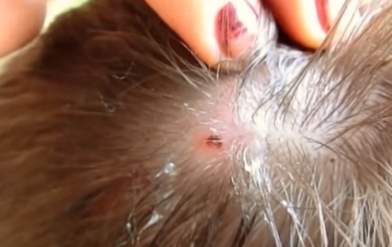 شاهد.. ماذا وجدوا بداخل رأسه؟!