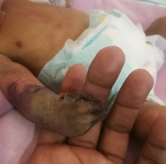 بعد الطفل جسار.. بتر كف الرضيع منصور بعد جراحة استغرقت ساعتين وهذا مطلب أسرته! بعد الطفل جسار.. بتر كف الرضيع منصور بعد جراحة استغرقت ساعتين وهذا مطلب أسرته!