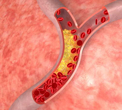 مادة الكارنتين تتحول لمادة كيميائية في الكبد تختلط بالدم فتغلق الاوعية الدموية في الجسم