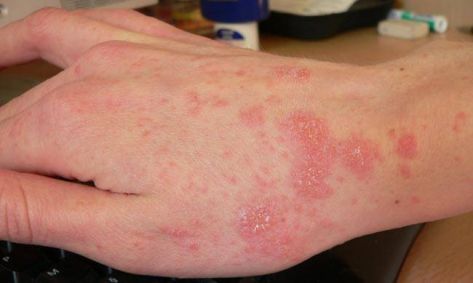 ''الصحة'': إصابة 226 شخصاً بمرض ''الجرب'' في إربد