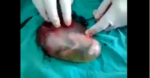 بالفيديو : هل رأيت جنين في مشيمة من قبل