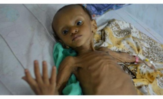 34 وفاة بالكوليرا والاشتباه بألفي إصابة أخرى في اليمن